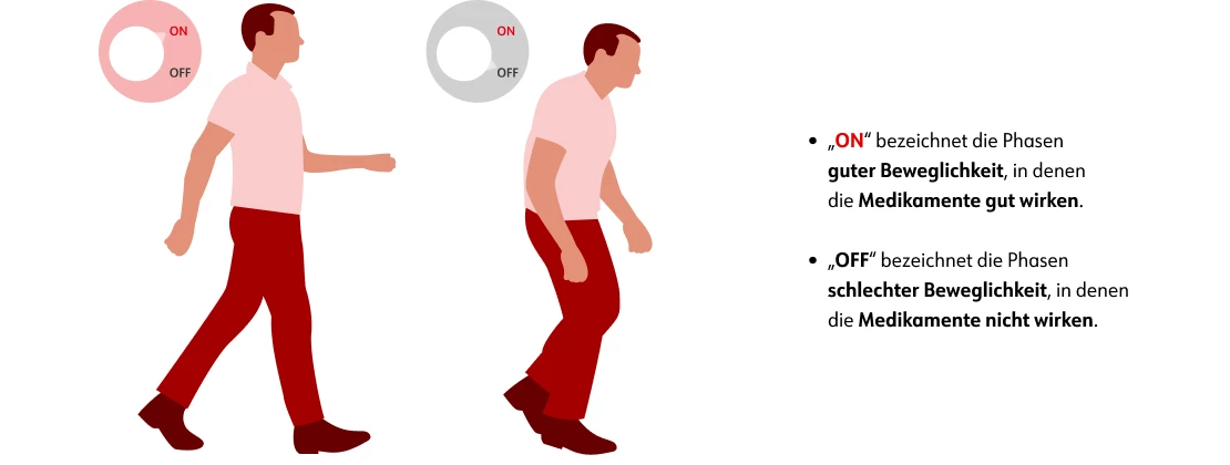 ON-Off-Phänomen bei Morbus Parkinson