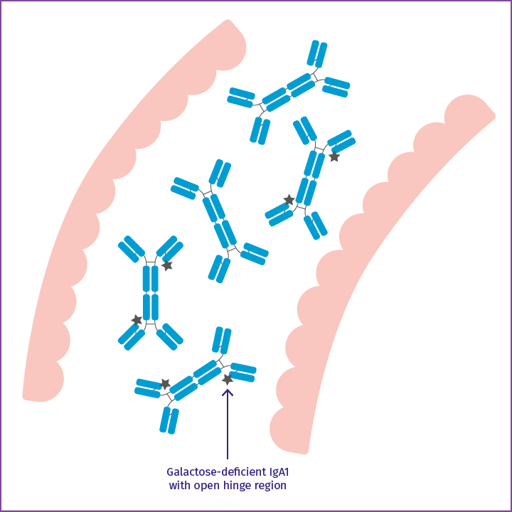 Illustration showing galactose-deficient IgA1 with open hinge region